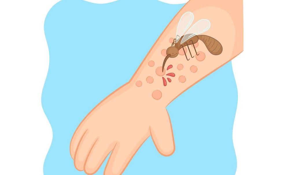 Медики Чувашии отметили рост аллергий на комариные укусы у детей