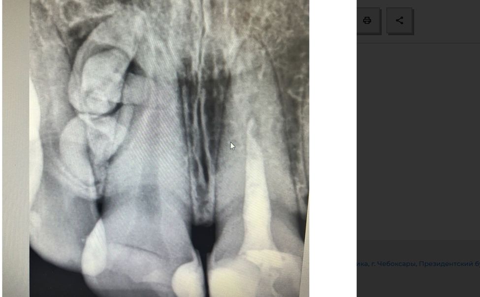 Чебоксарке удалили аномальное новообразование во рту 