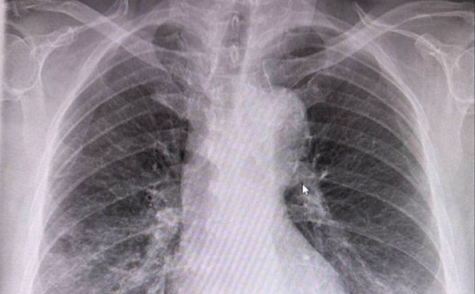 Самолечение привело чебоксарца в реанимацию