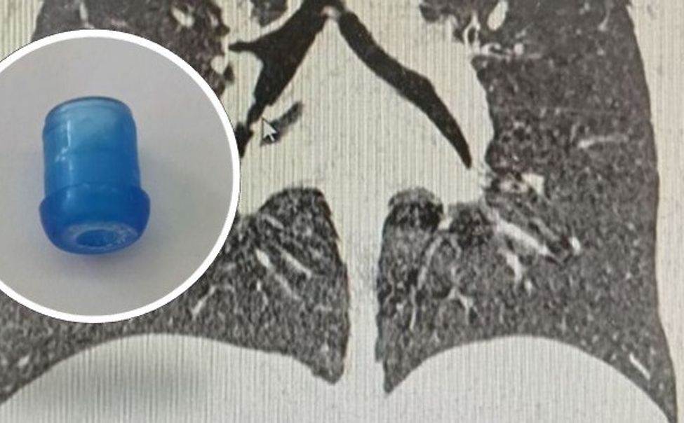 В Чувашии хирурги детской больницы извлекли 38 инородных тел с начала года