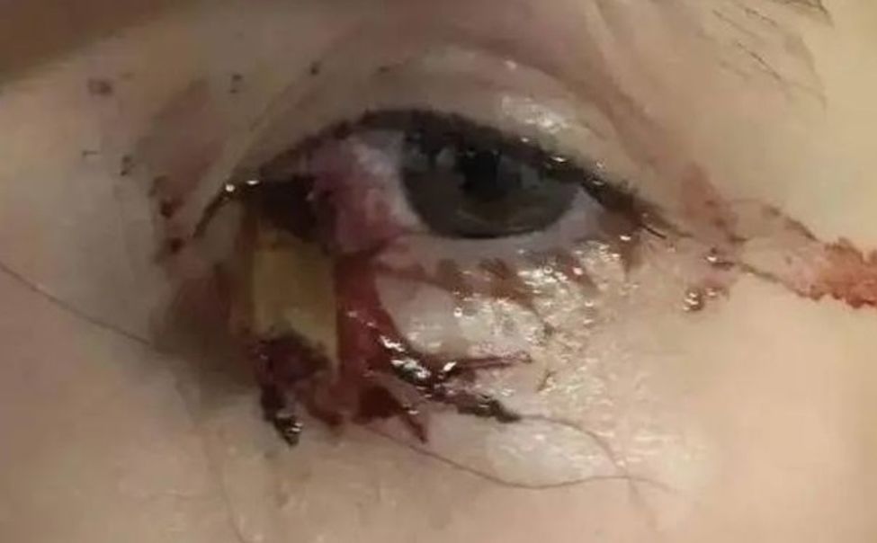 Чувашские офтальмологи помогли девушке, повредившей глаз камышом