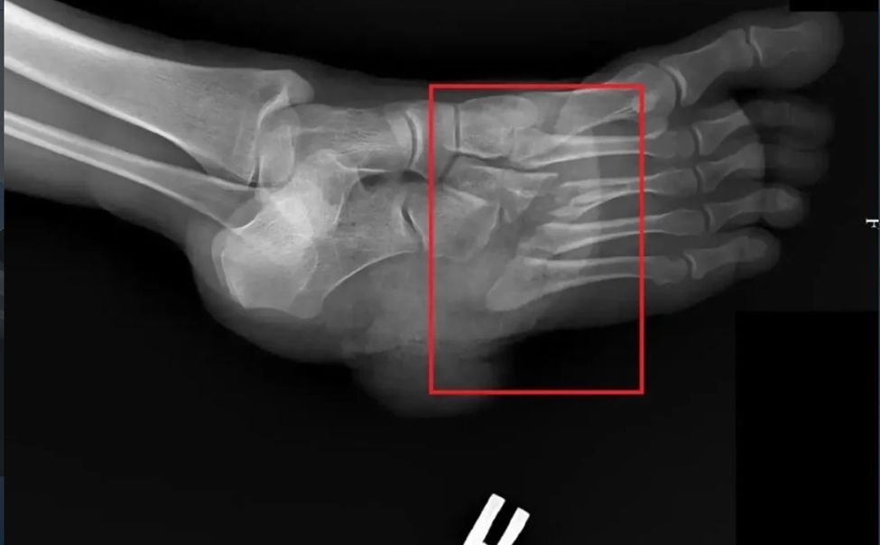 Новочебоксарка повредила ногу топором во время ремонта