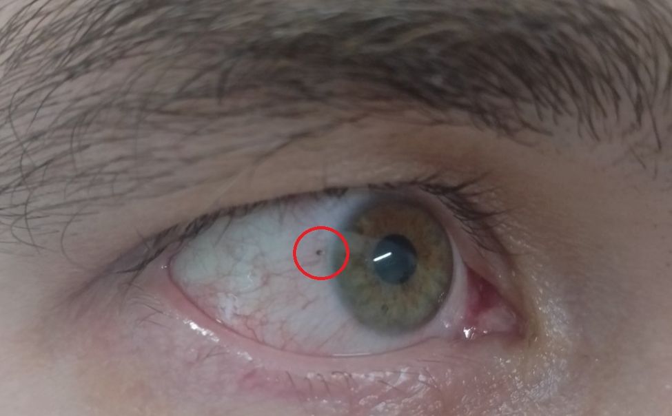 В Чувашии офтальмологи помогли мужчине, который косил траву и травмировал глаз
