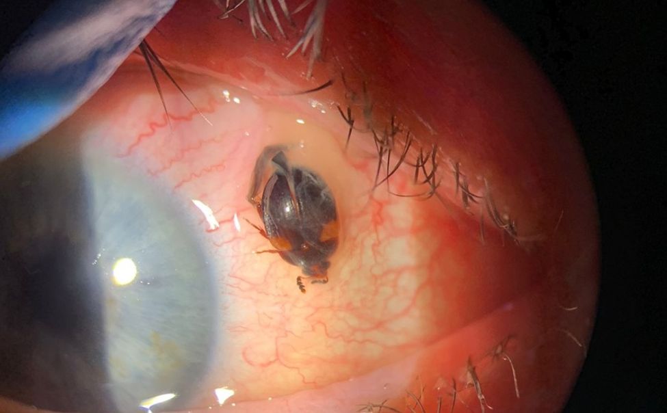 Чувашские офтальмологи извлекли из глаза пациентки...насекомое