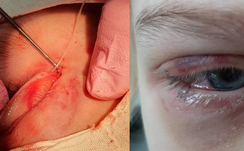 В Чувашии врачи прооперировали девочку, на которую напала собака