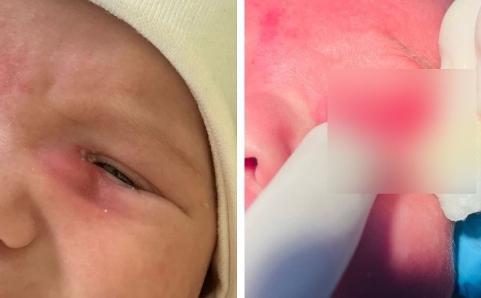 В Чувашии офтальмологи экстренно прооперировали двухмесячного ребенка