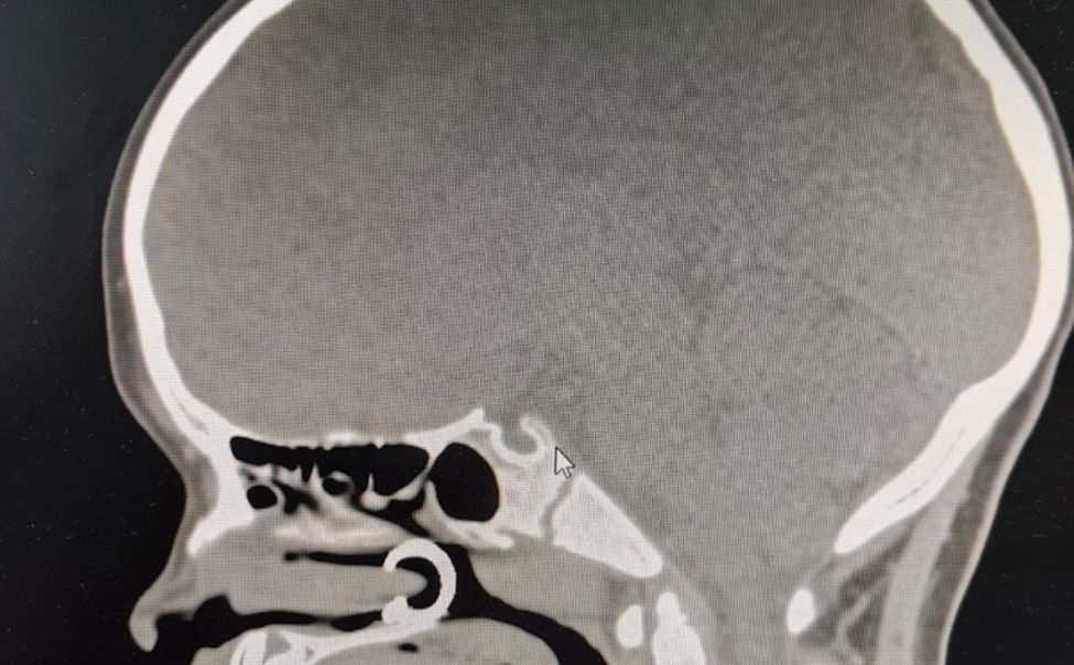 Чебоксарские врачи спасли девочку, вдохнувшую через нос сережку-пирсинг