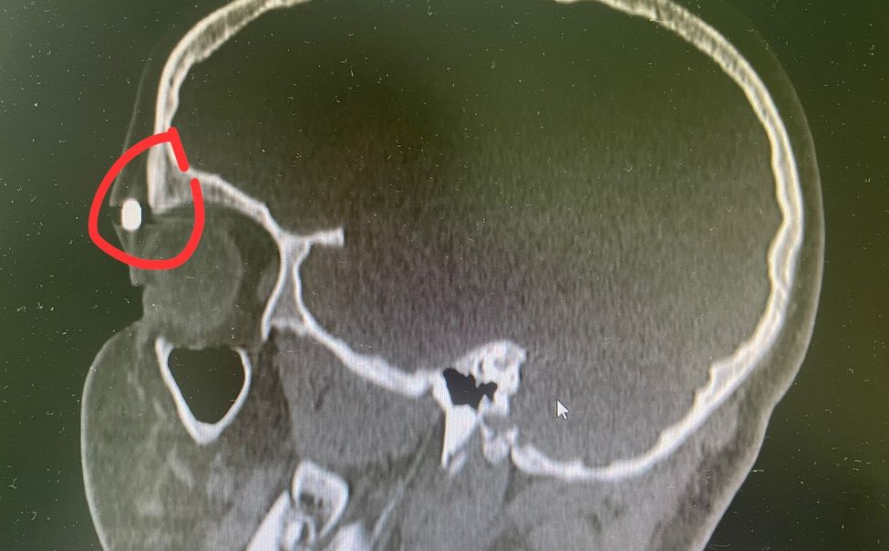 В Чувашии 10-летний мальчик получил ранение в лоб из пневматического оружия