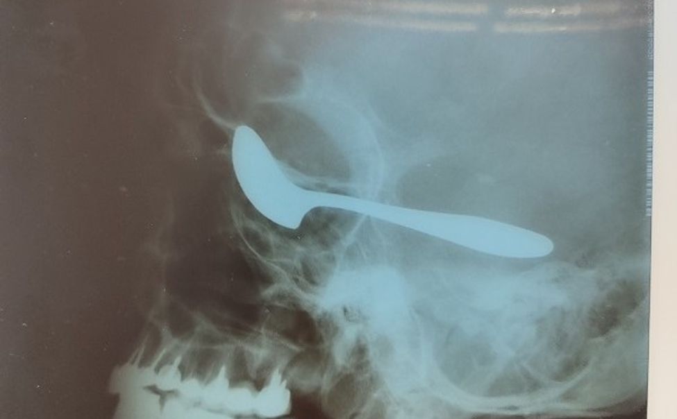 В Чувашии пациент с белой горячкой загнал себе ложку в глаз
